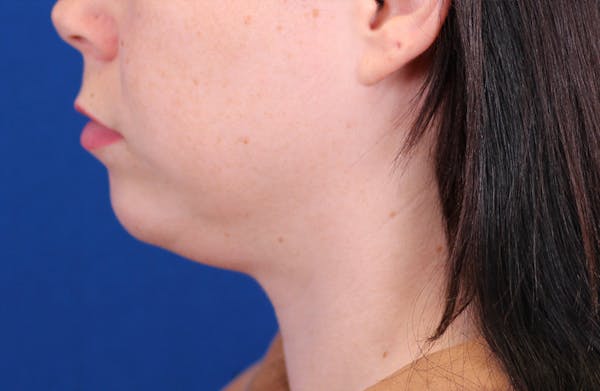 Neck deFINE Before & After Gallery - Patient 148021161 - Image 3