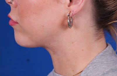 Neck deFINE Before & After Gallery - Patient 148021161 - Image 4