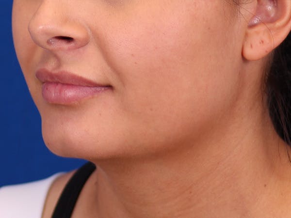 Lip Augmentation Before & After Gallery - Patient 148099079 - Image 7