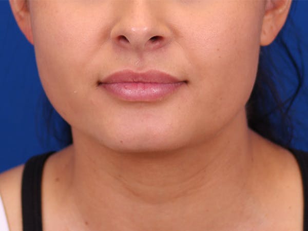 Lip Augmentation Before & After Gallery - Patient 148099079 - Image 1