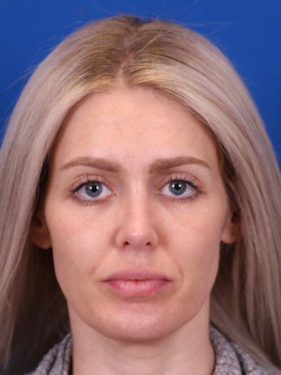 Rhinoplasty Before & After Gallery - Patient 148128708 - Image 4