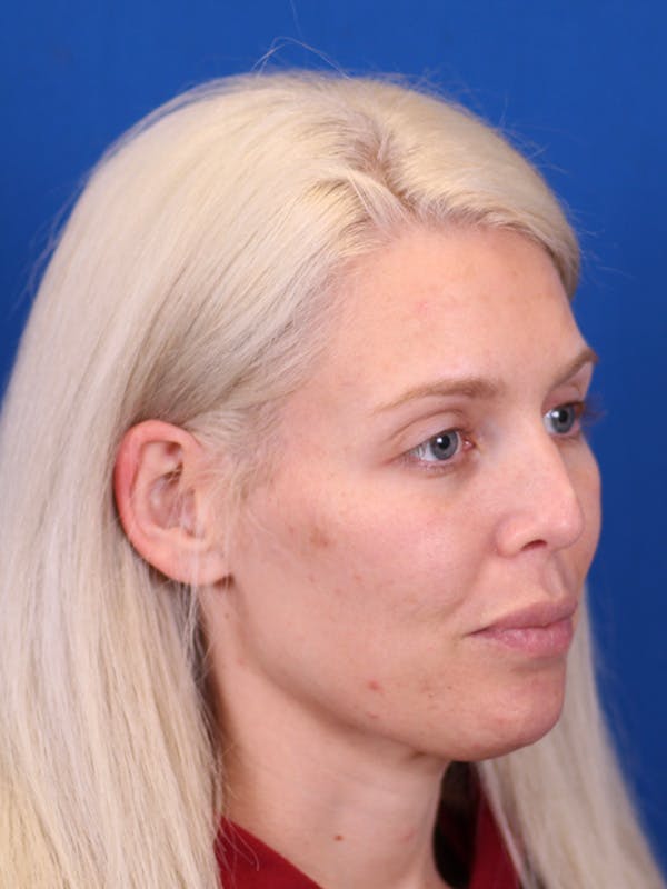 Rhinoplasty Before & After Gallery - Patient 148128708 - Image 5
