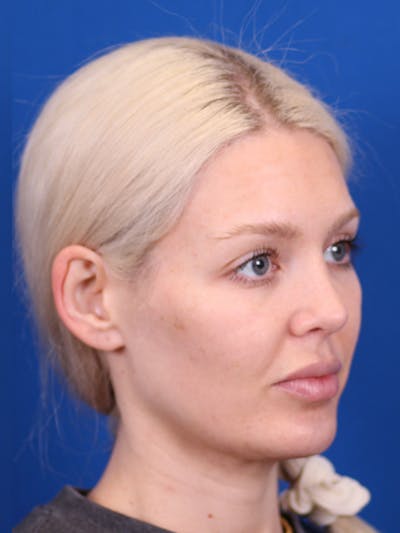 Rhinoplasty Before & After Gallery - Patient 148128708 - Image 6