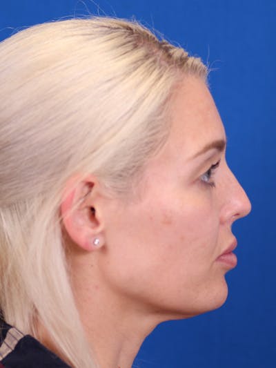 Rhinoplasty Before & After Gallery - Patient 148128708 - Image 1