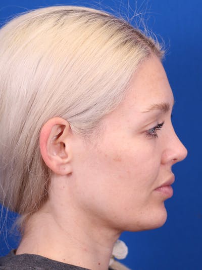Rhinoplasty Before & After Gallery - Patient 148128708 - Image 2