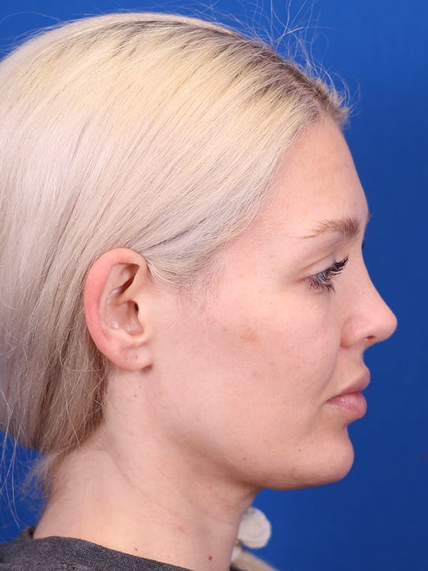 Neck deFINE Before & After Gallery - Patient 148128709 - Image 2