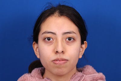 Rhinoplasty Before & After Gallery - Patient 144176079 - Image 1