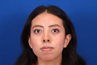 Rhinoplasty Before & After Gallery - Patient 144176079 - Image 2