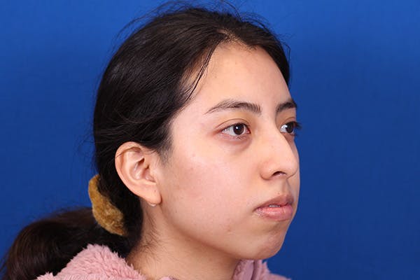 Rhinoplasty Before & After Gallery - Patient 144176079 - Image 3