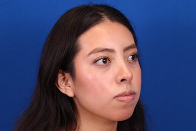 Rhinoplasty Before & After Gallery - Patient 144176079 - Image 4