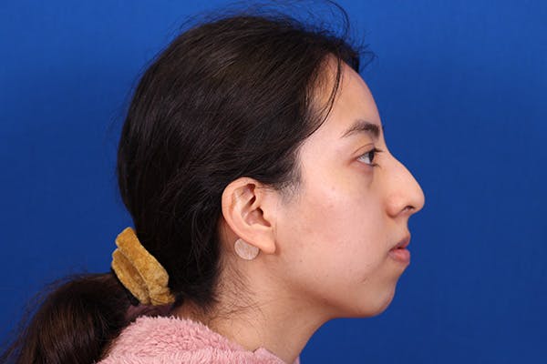 Rhinoplasty Before & After Gallery - Patient 144176079 - Image 5