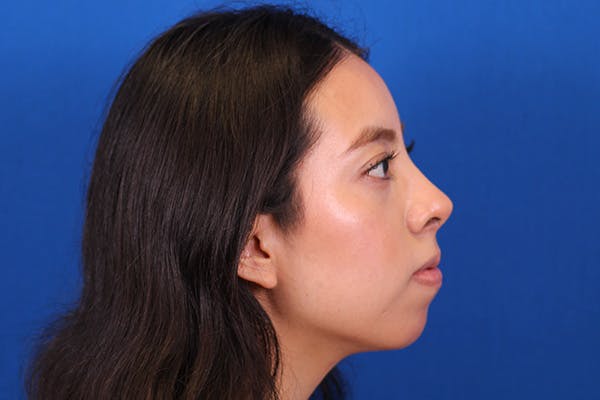 Rhinoplasty Before & After Gallery - Patient 144176079 - Image 6