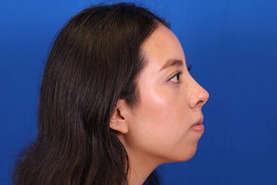 Rhinoplasty Before & After Gallery - Patient 144176079 - Image 6