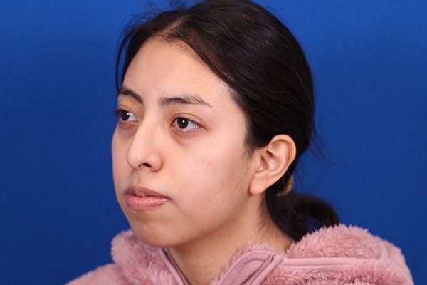 Rhinoplasty Before & After Gallery - Patient 144176079 - Image 7