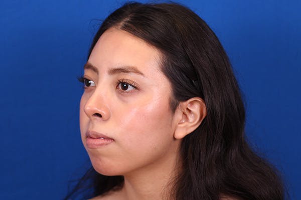 Rhinoplasty Before & After Gallery - Patient 144176079 - Image 8