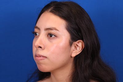 Rhinoplasty Before & After Gallery - Patient 144176079 - Image 8