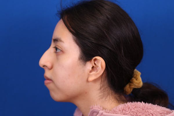 Rhinoplasty Before & After Gallery - Patient 144176079 - Image 9