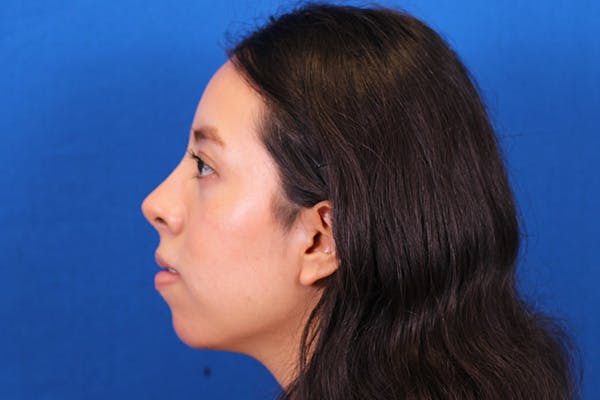 Rhinoplasty Before & After Gallery - Patient 144176079 - Image 10