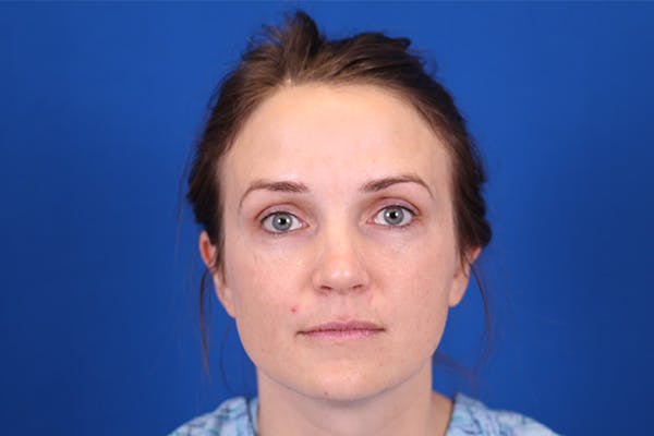 Rhinoplasty Before & After Gallery - Patient 148193952 - Image 3
