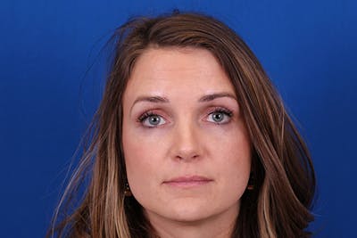 Rhinoplasty Before & After Gallery - Patient 148193952 - Image 4