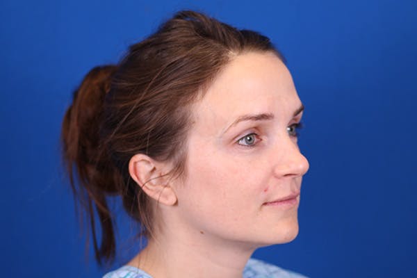 Rhinoplasty Before & After Gallery - Patient 148193952 - Image 5