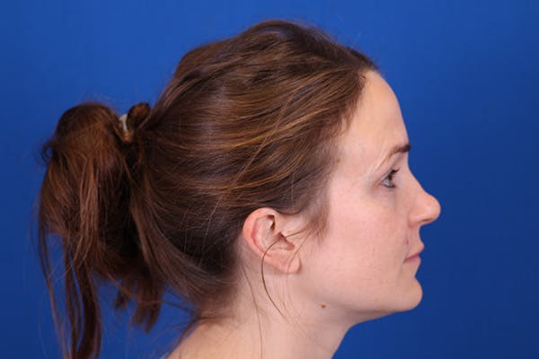 Rhinoplasty Before & After Gallery - Patient 148193952 - Image 7