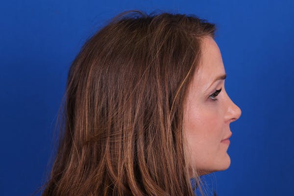 Rhinoplasty Before & After Gallery - Patient 148193952 - Image 8