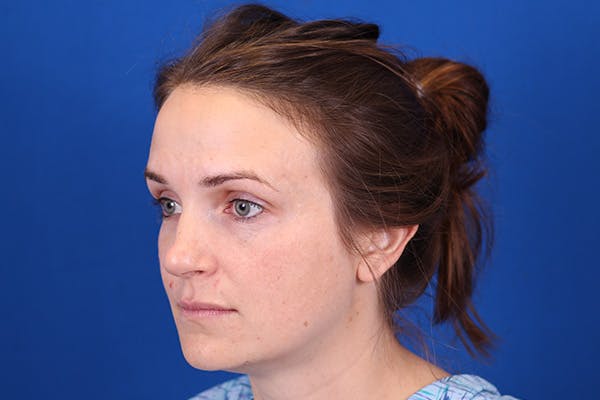 Rhinoplasty Before & After Gallery - Patient 148193952 - Image 9