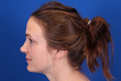 Rhinoplasty Before & After Gallery - Patient 148193952 - Image 1