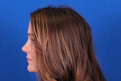 Rhinoplasty Before & After Gallery - Patient 148193952 - Image 2