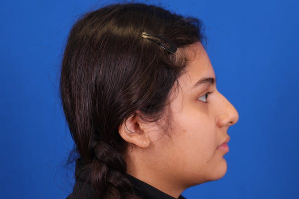 Rhinoplasty Before & After Gallery - Patient 148216622 - Image 7