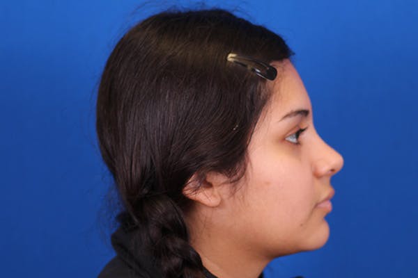 Rhinoplasty Before & After Gallery - Patient 148216622 - Image 8