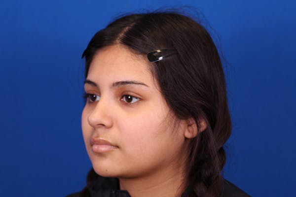 Rhinoplasty Before & After Gallery - Patient 148216622 - Image 10