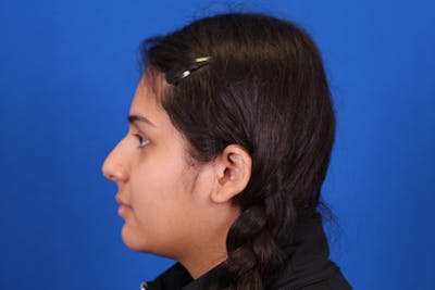 Rhinoplasty Before & After Gallery - Patient 148216622 - Image 1