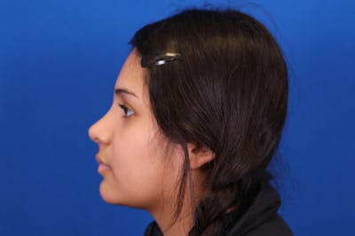 Rhinoplasty Before & After Gallery - Patient 148216622 - Image 2