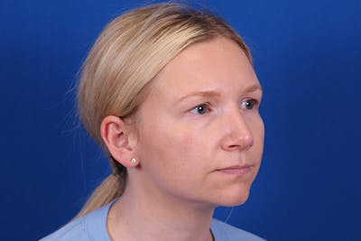 Rhinoplasty Before & After Gallery - Patient 148216625 - Image 6