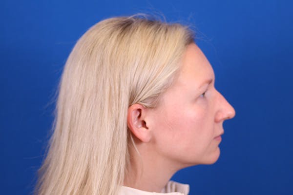 Rhinoplasty Before & After Gallery - Patient 148216625 - Image 7