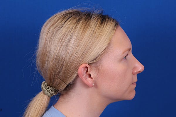 Rhinoplasty Before & After Gallery - Patient 148216625 - Image 8
