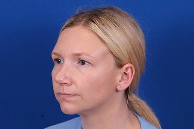 Rhinoplasty Before & After Gallery - Patient 148216625 - Image 10