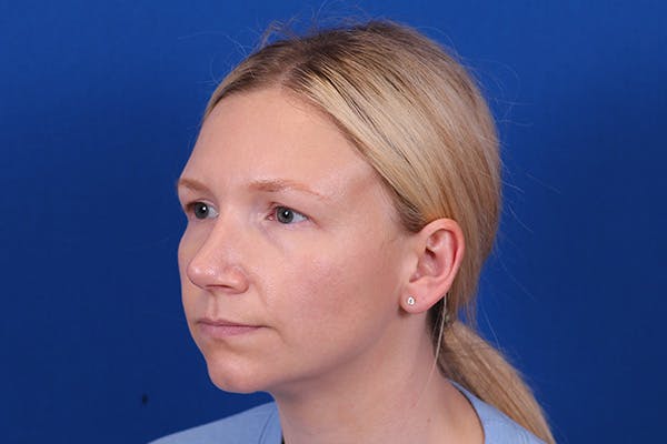 Rhinoplasty Before & After Gallery - Patient 148216625 - Image 10
