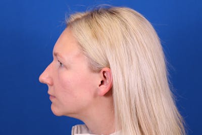 Rhinoplasty Before & After Gallery - Patient 148216625 - Image 1