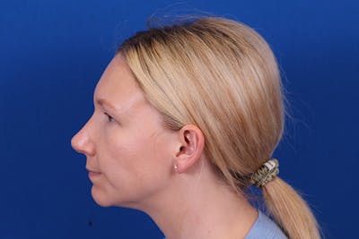 Rhinoplasty Before & After Gallery - Patient 148216625 - Image 2