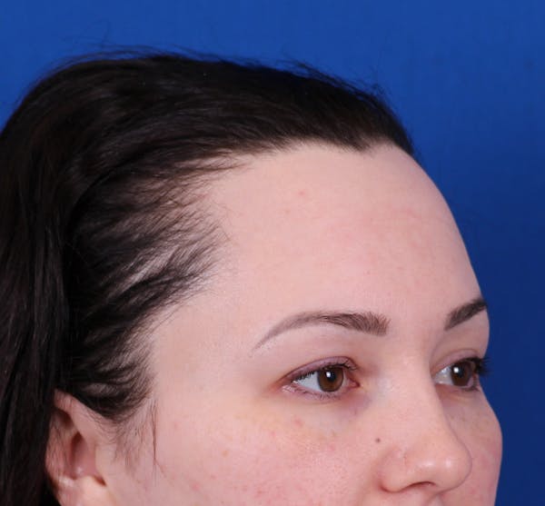 Brow Lift Before & After Gallery - Patient 148703123 - Image 3