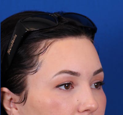 Brow Lift Before & After Gallery - Patient 148703123 - Image 4