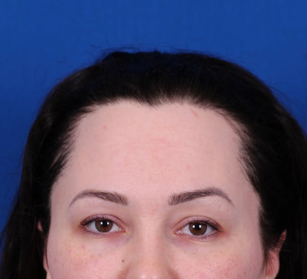 Brow Lift Before & After Gallery - Patient 148703123 - Image 1