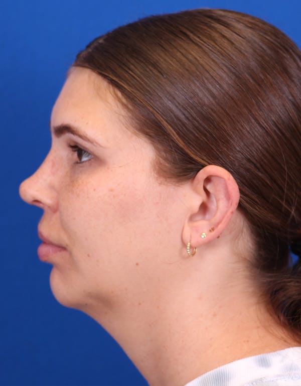 Neck deFINE Before & After Gallery - Patient 148703135 - Image 3