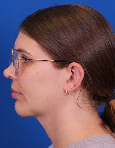 Neck deFINE Before & After Gallery - Patient 148703135 - Image 4
