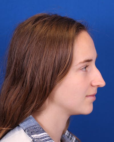 Rhinoplasty Before & After Gallery - Patient 148703149 - Image 1