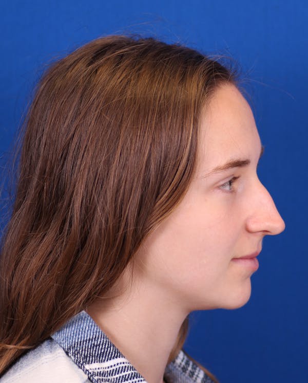 Rhinoplasty Before & After Gallery - Patient 148703149 - Image 1