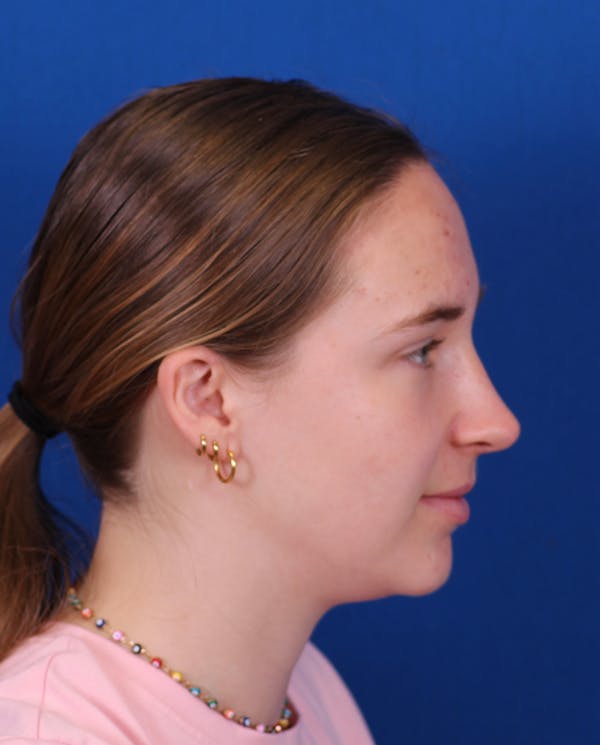 Rhinoplasty Before & After Gallery - Patient 148703149 - Image 2